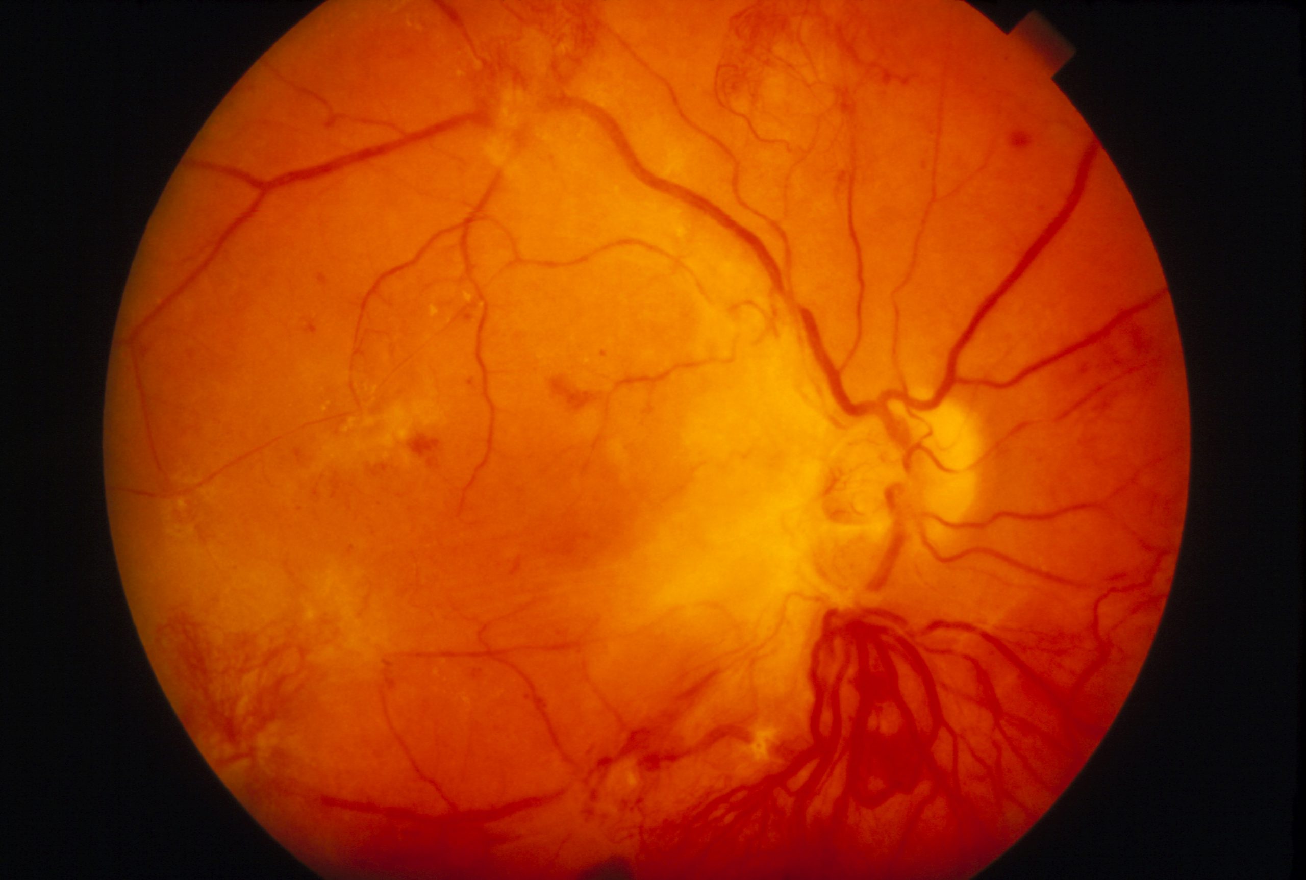 Истончение сетчатки. Препролиферативная ретинопатия. Диабетическая ретинопатия. Диабетическая ретинопатия отслойка сетчатки. Пролиферативная и непролиферативная ретинопатия.